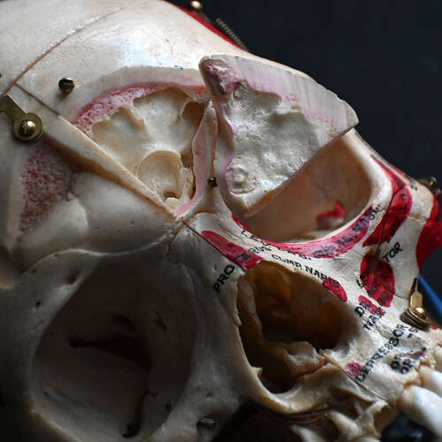 Medical cut skull